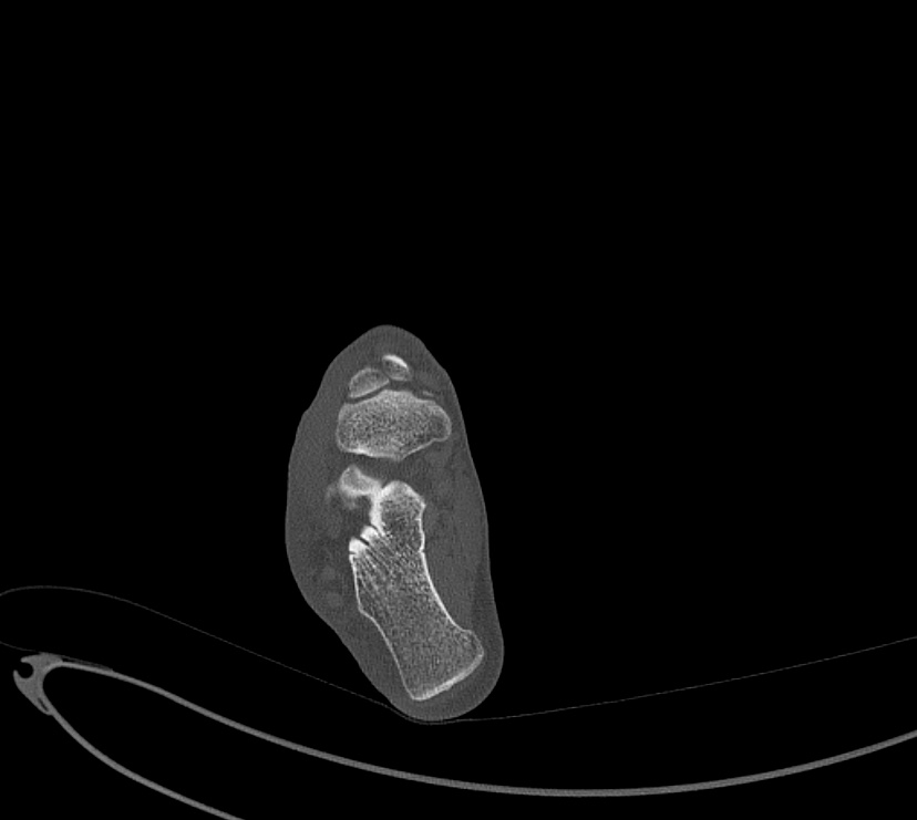 Avulsion fractures of talus and calcaneus (Radiopaedia 48277-53155 Axial bone window 64).jpg