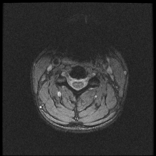 File:Axis fracture - MRI (Radiopaedia 71925-82375 Axial T2 fat sat 11).jpg