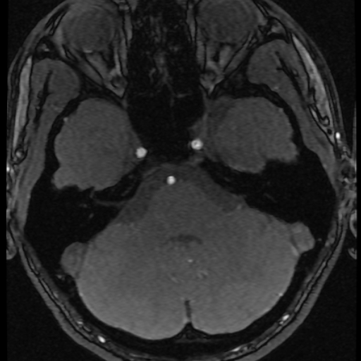 File:Azygos anterior cerebral artery (Radiopaedia 17059-16756 Axial MRA 67).jpg