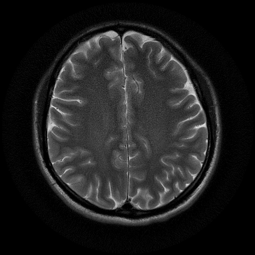 File:Azygos anterior cerebral artery (Radiopaedia 17059-16756 Axial T2 8).jpg