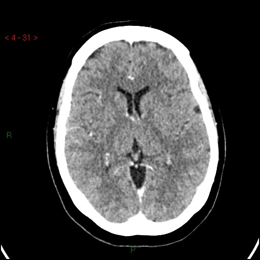 Azygos anterior cerebral artery (Radiopaedia 51987-57833 A 31).jpg