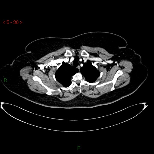 File:Azygos fissure and lobe (Radiopaedia 47620-52278 A 16).jpg