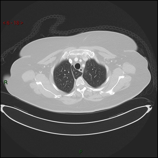 Azygos fissure and lobe (Radiopaedia 47620-52278 Axial lung window 18).jpg