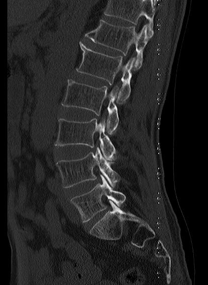 File:Baastrup syndrome (Radiopaedia 64891-73838 Sagittal bone window 15).jpg