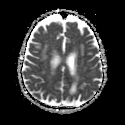 File:Balo concentric sclerosis (Radiopaedia 53875-59982 Axial ADC 17).jpg