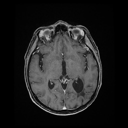Balo concentric sclerosis (Radiopaedia 53875-59982 Axial LAVA C+ 129).jpg