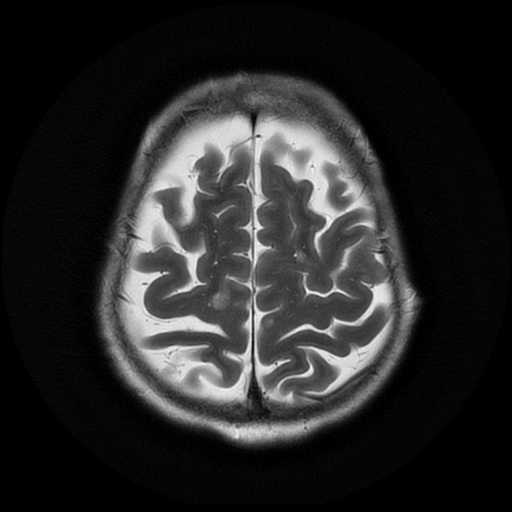 File:Balo concentric sclerosis (Radiopaedia 53875-59982 Axial T2 21).jpg