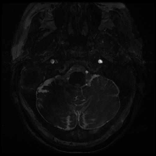 Balo concentric sclerosis (Radiopaedia 53875-59982 Axial T2 FIESTA 3).jpg
