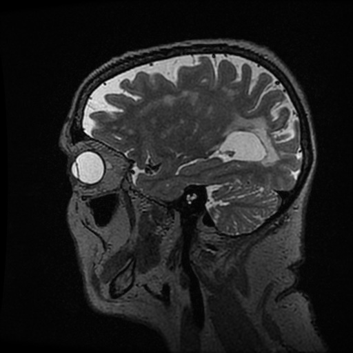 Balo concentric sclerosis (Radiopaedia 53875-59982 Sagittal 3D FSE 81).jpg