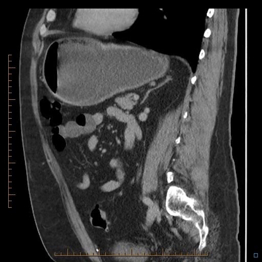 File:Bariatric balloon causing gastric outlet obstruction (Radiopaedia 54449-60672 C 32).jpg