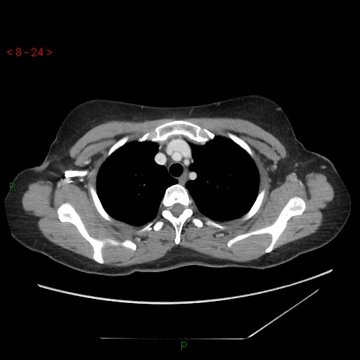 Bartholin gland cyst (Radiopaedia 54904-61181 A 6).jpg