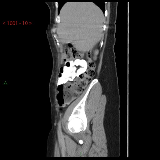 File:Bartholin gland cyst (Radiopaedia 54904-61181 Sagittal C+ delayed 10).jpg