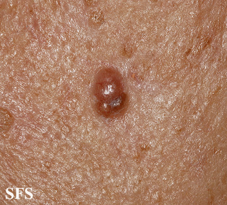 Basal Cell Carcinoma (Dermatology Atlas 216).jpg