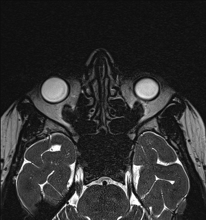 Basal cell carcinoma - nasal region (Radiopaedia 70292-80365 Axial Gradient Echo 61).jpg