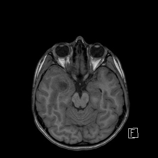 Base of skull rhabdomyosarcoma (Radiopaedia 32196-33142 Axial T1 19).jpg