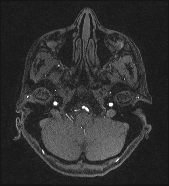 Basilar artery perforator aneurysm (Radiopaedia 82455-97733 Axial MRA 45).jpg