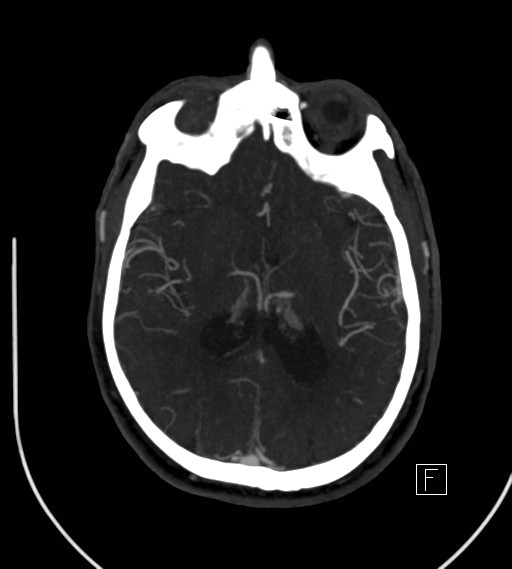 Basilar artery thrombosis (Radiopaedia 26986-27163 A 50).jpg