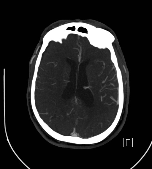 Basilar artery thrombosis (Radiopaedia 26986-27163 A 55).jpg