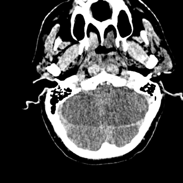 File:Basilar artery thrombosis (Radiopaedia 53351-59352 Axial non-contrast 29).jpg
