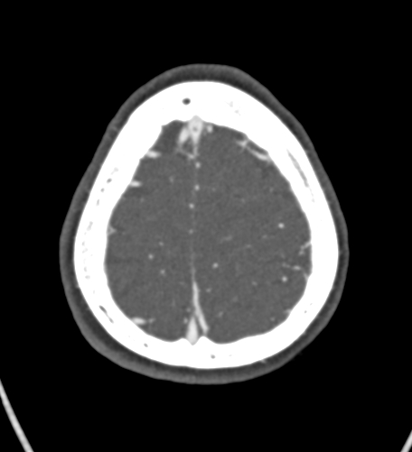 Basilar tip aneurysm with coiling (Radiopaedia 53912-60086 A 130).jpg