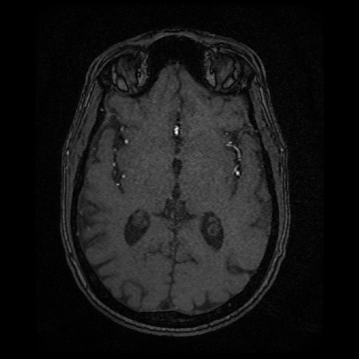 Basilar top and left middle cerebral artery aneurysm (Radiopaedia 61965-70031 Axial MRA 82).jpg