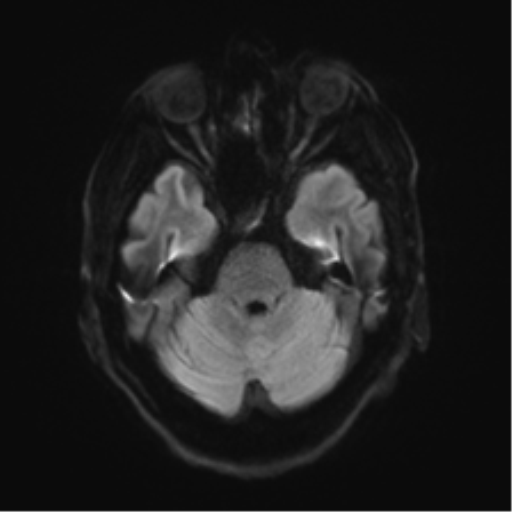 File:Behavioral variant frontotemporal dementia and late onset schizophrenia (Radiopaedia 52197-58083 Axial DTI Trace W 35).png