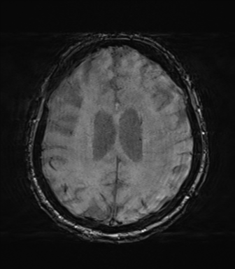 File:Behavioral variant frontotemporal dementia and late onset schizophrenia (Radiopaedia 52197-58083 Axial SWI 50).png