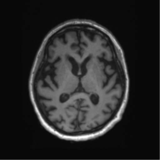 Behavioral variant frontotemporal dementia and late onset schizophrenia (Radiopaedia 52197-58083 Axial T1 48).png