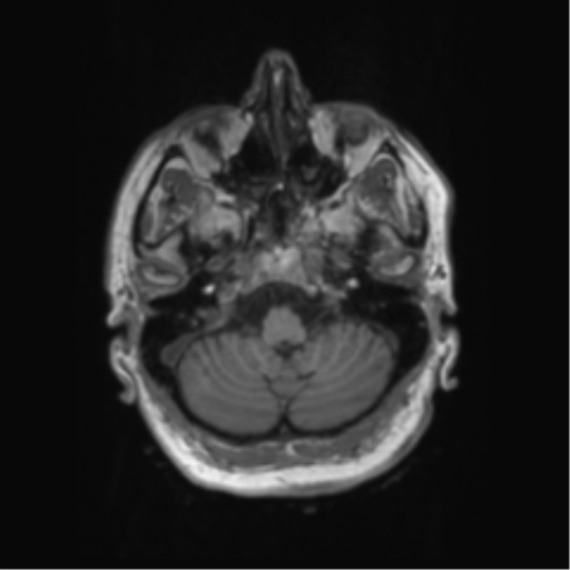 Behavioral variant frontotemporal dementia and late onset schizophrenia (Radiopaedia 52197-58083 Axial T1 93).png