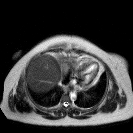 File:Benign seromucinous cystadenoma of the ovary (Radiopaedia 71065-81300 Axial T2 23).jpg