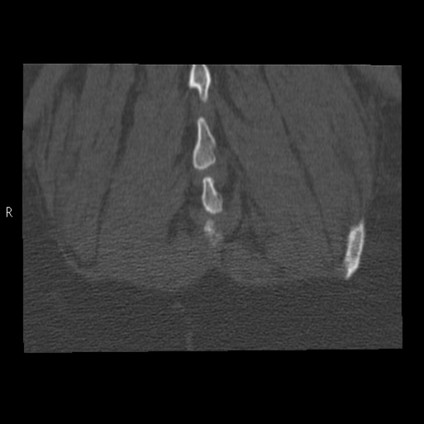 Bertolotti syndrome (Radiopaedia 24864-25128 Coronal bone window 49).jpg