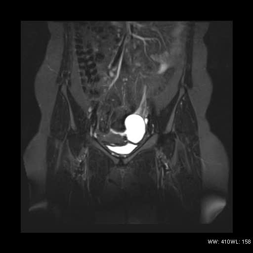 File:Bicornuate uterus- on MRI (Radiopaedia 49206-54297 Coronal STIR 5).jpg