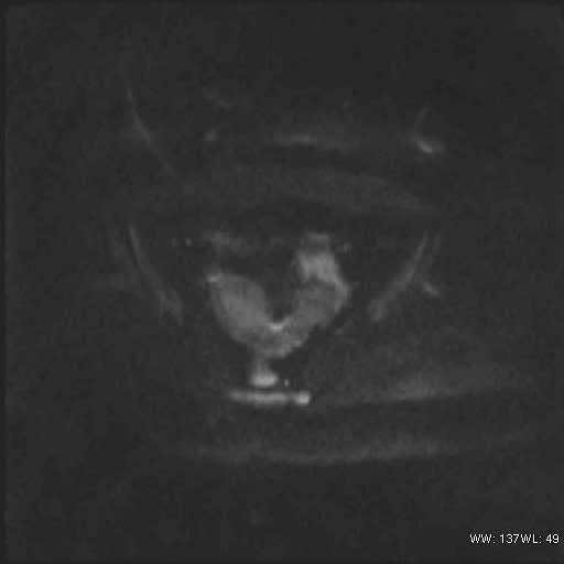 File:Bicornuate uterus (MRI) (Radiopaedia 49206-54297 Axial 100).jpg