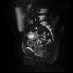 File:Bicornuate uterus (Radiopaedia 51676-57472 Sagittal DWI 41).jpg