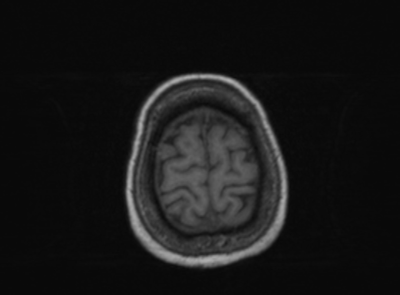 File:Bilateral PCA territory infarction - different ages (Radiopaedia 46200-51784 Axial T1 133).jpg