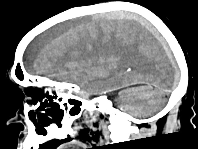 Bilateral acute on chronic subdural hematomas (Radiopaedia 78466-91146 C 37).jpg