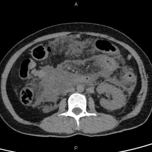 Bilateral adrenal gland hyperenhancement in pancreatitis (Radiopaedia 86642-102753 Axial non-contrast 55).jpg