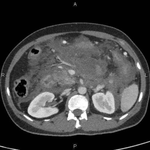 Bilateral adrenal gland hyperenhancement in pancreatitis (Radiopaedia 86642-102753 E 41).jpg