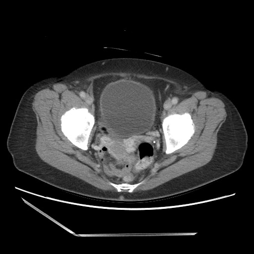 Bilateral adrenal granulocytic sarcomas (chloromas) (Radiopaedia 78375-91007 A 106).jpg