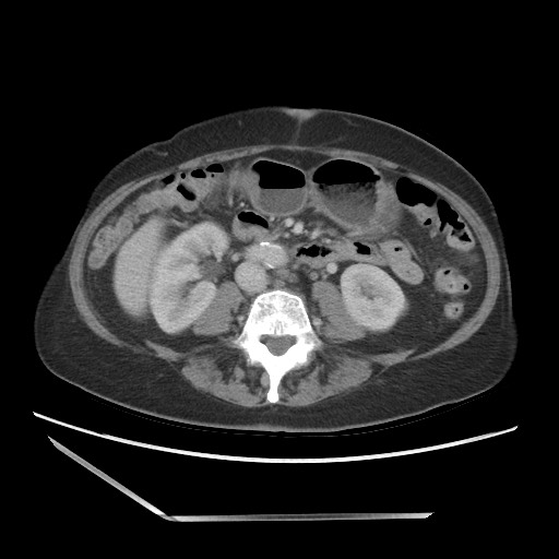 Bilateral adrenal granulocytic sarcomas (chloromas) (Radiopaedia 78375-91007 A 64).jpg