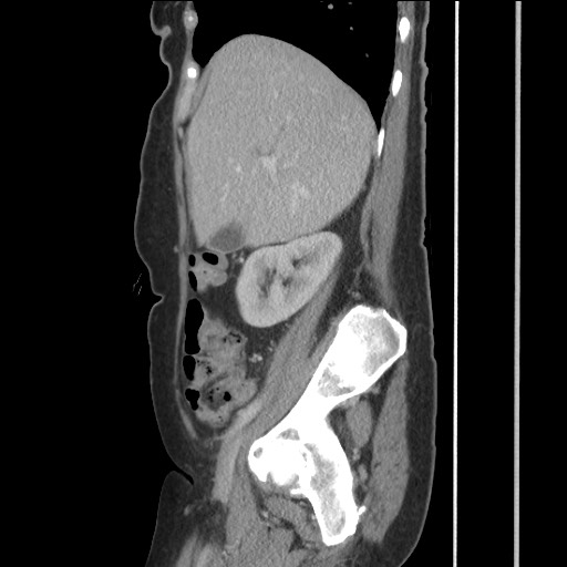 Bilateral adrenal granulocytic sarcomas (chloromas) (Radiopaedia 78375-91007 C 49).jpg