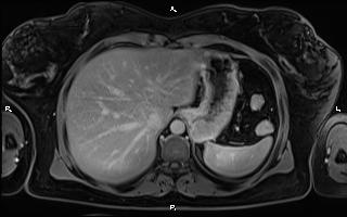 File:Bilateral adrenal myelolipoma (Radiopaedia 63058-71537 H 21).jpg