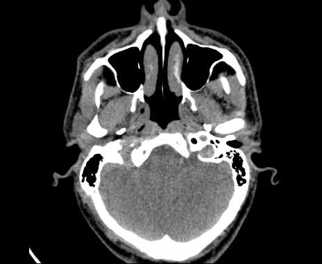 Bilateral carotid body tumors (Radiopaedia 61841-69870 Axial non-contrast 6).jpg