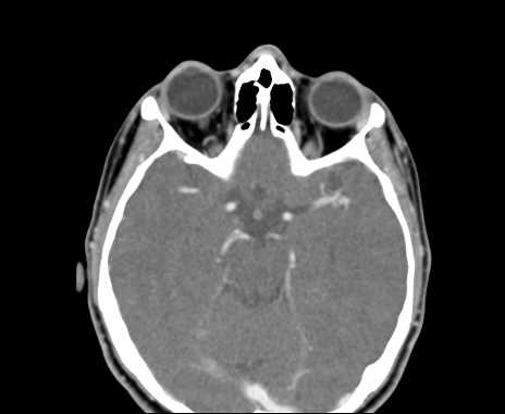 File:Bilateral carotid body tumors and left glomus jugulare tumor (Radiopaedia 61846).jpg