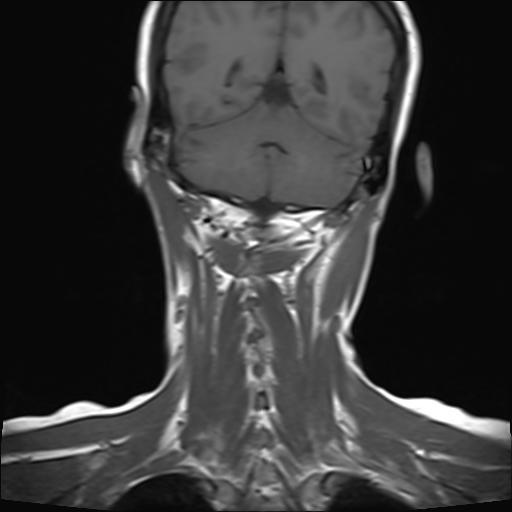 File:Bilateral carotid body tumors and right jugular paraganglioma (Radiopaedia 20024-20060 Coronal 20).jpg