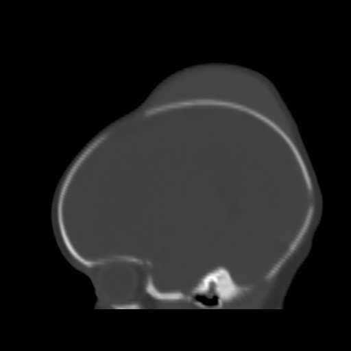 File:Bilateral cephalohematomas and subdural hematomas (Radiopaedia 26778-26929 Sagittal bone window 13).jpg