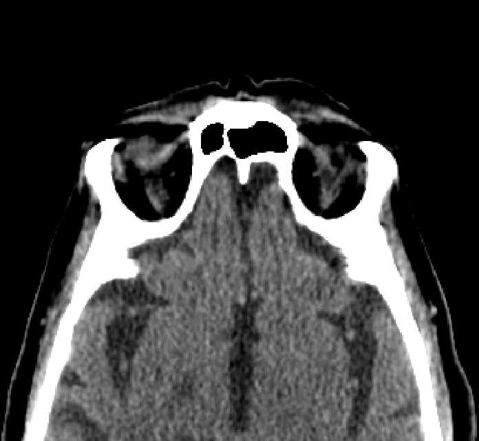 Bilateral ectopia lentis (Radiopaedia 89889-107013 Axial non-contrast 14).jpg