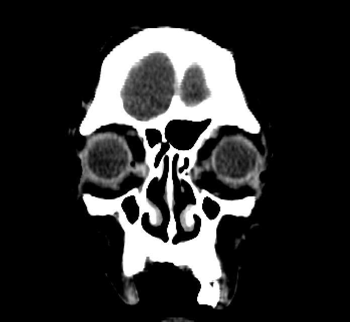 Bilateral ectopia lentis (Radiopaedia 89889-107013 Coronal non-contrast 20).jpg