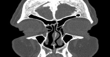 File:Bilateral ectopic infraorbital nerves (Radiopaedia 49006-54084 Coronal 61).png