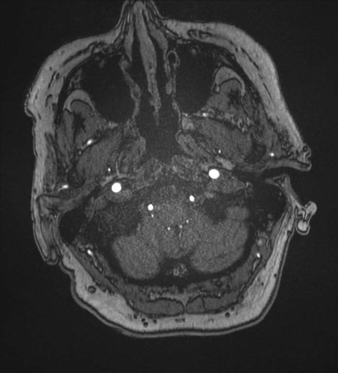Bilateral fetal posterior communicating arteries (Radiopaedia 41286-44102 Axial MRA 5).png